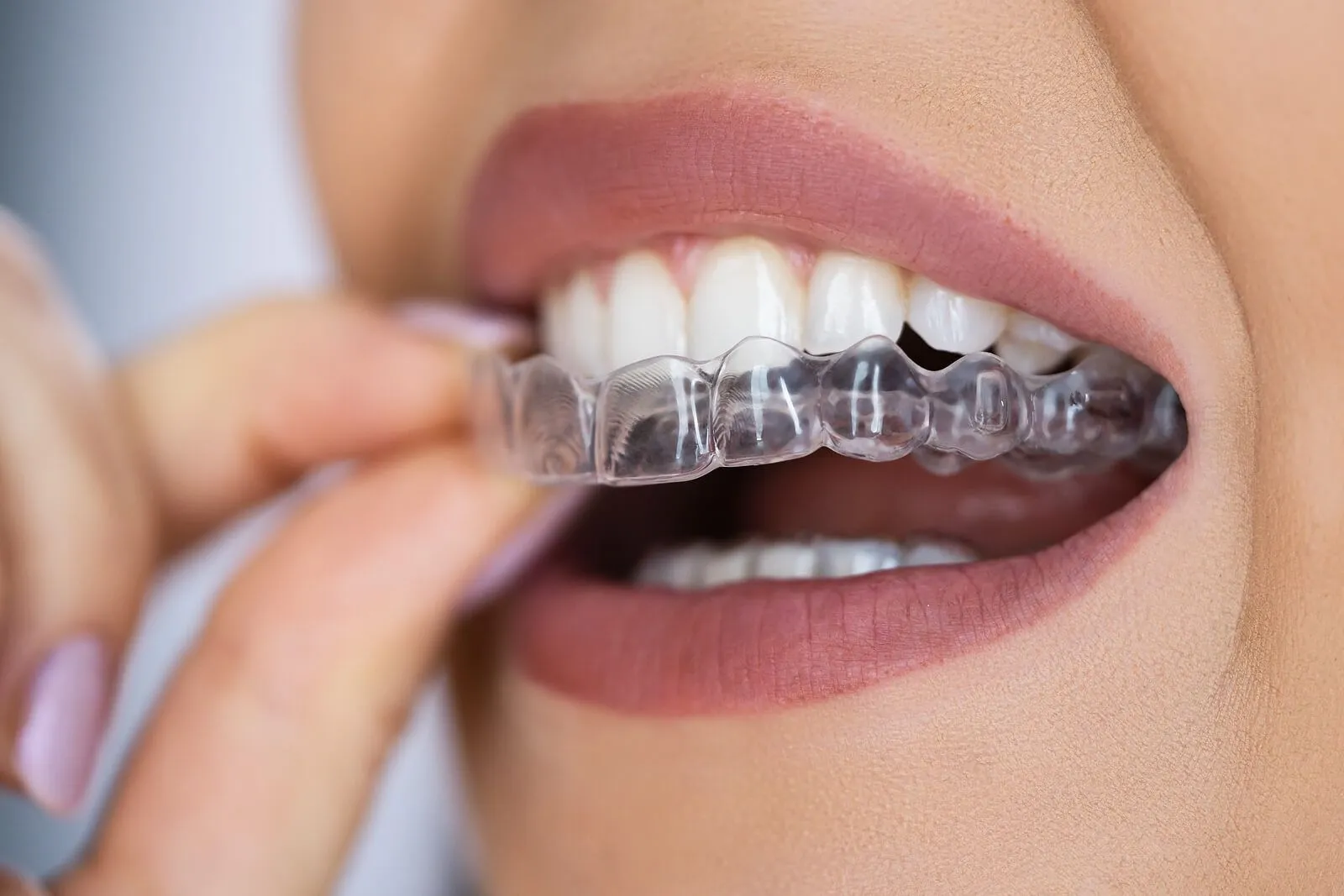 Aligners at Aurum Dental Clinic, Vadodara