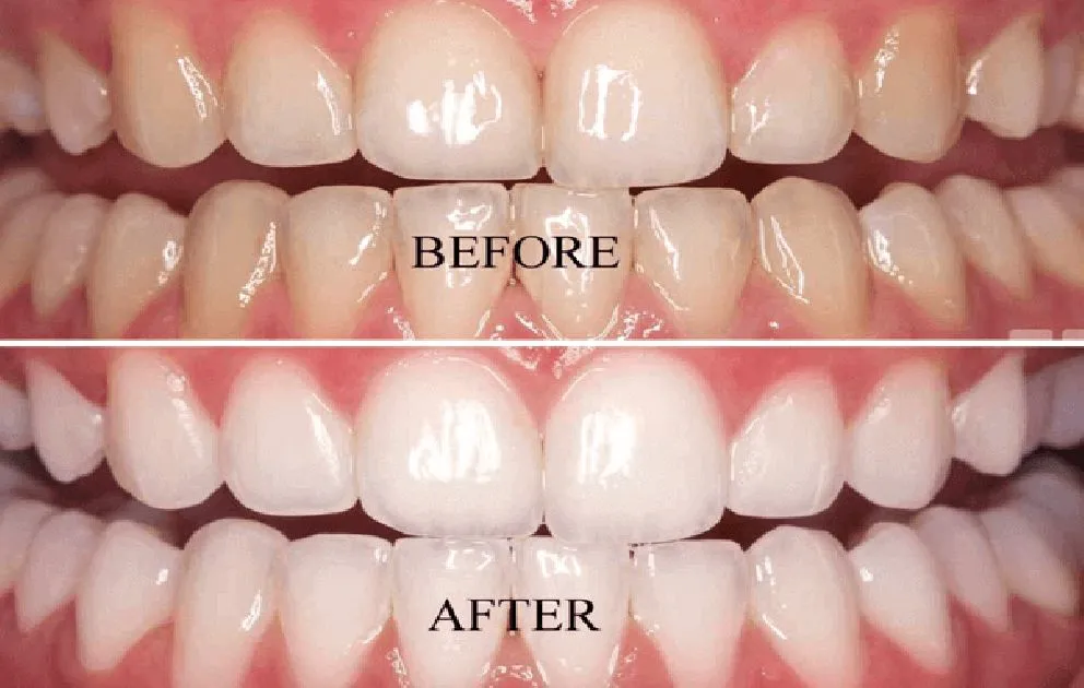 Clinician carrying out bleaching at Aurum Dental Clinic