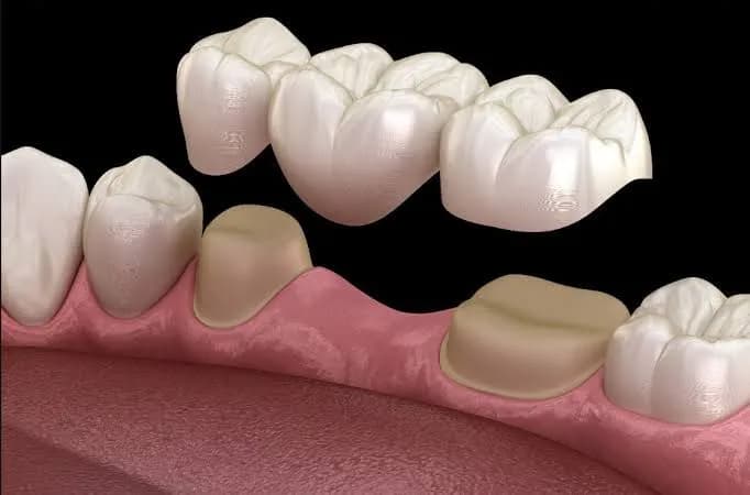 Clinician carrying out bridges at Aurum Dental Clinic