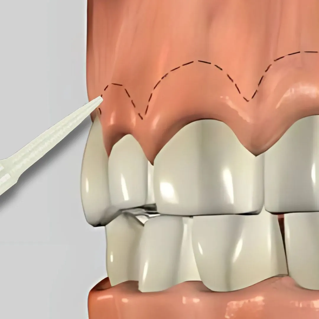 Crown Lengthening at Aurum Dental Clinic, Vadodara