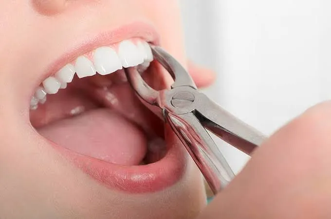 Clinician carrying out extraction at Aurum Dental Clinic