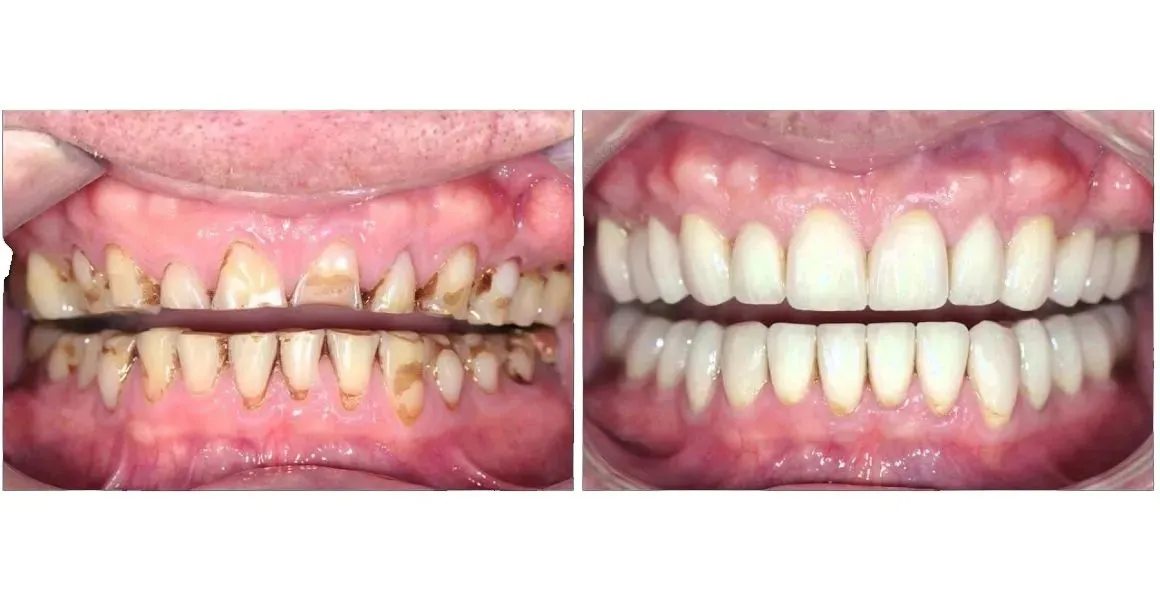 Full Mouth Rehabilitation at Aurum Dental Clinic, Vadodara