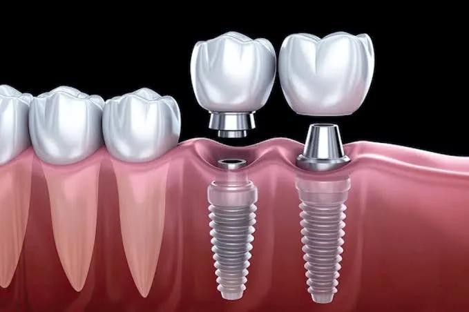 Clinician carrying out implants at Aurum Dental Clinic
