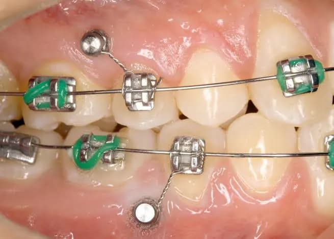 Clinician carrying out mini implants at Aurum Dental Clinic