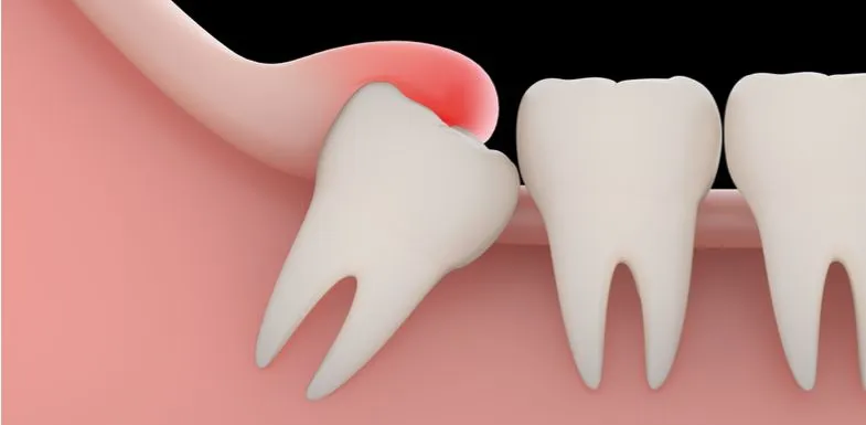 Clinician carrying out operculectomy at Aurum Dental Clinic