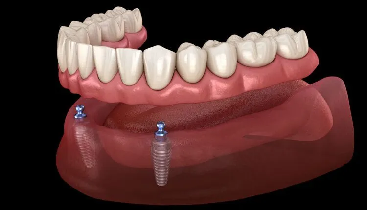 Clinician carrying out flexible and overdentures at Aurum Dental Clinic