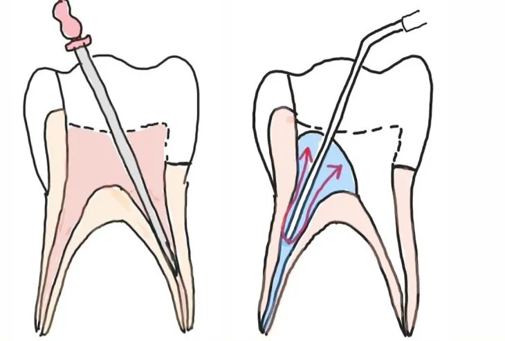 Clinician carrying out pulpectomy at Aurum Dental Clinic