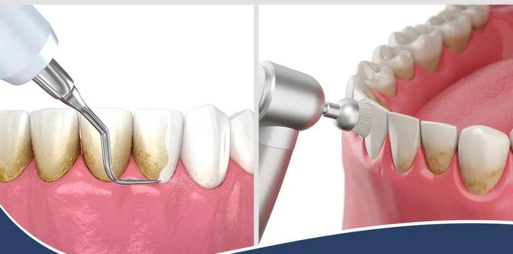 Periodontics at Aurum Dental Clinic, Vadodara