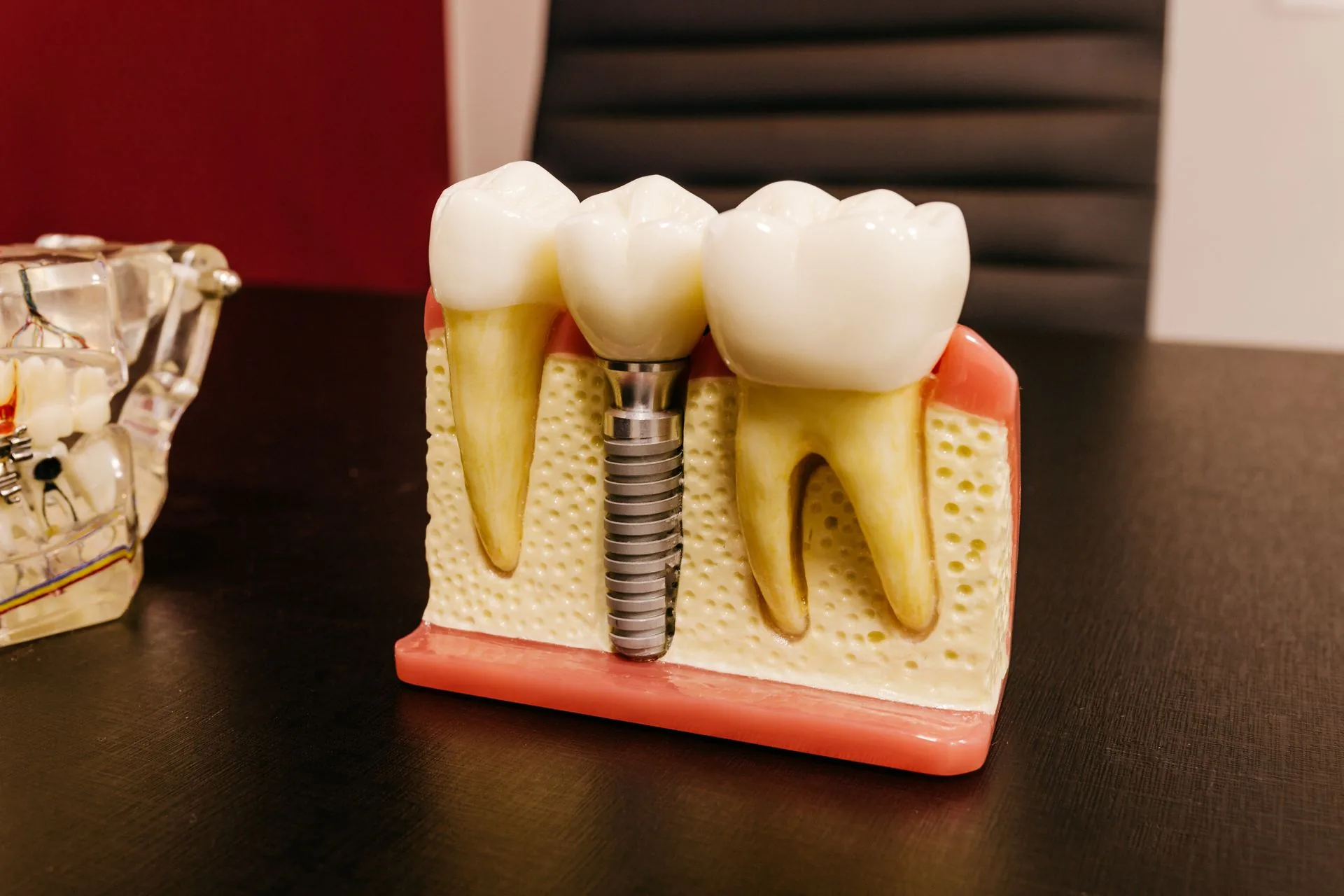 Bridges at Aurum Dental Clinic, Vadodara