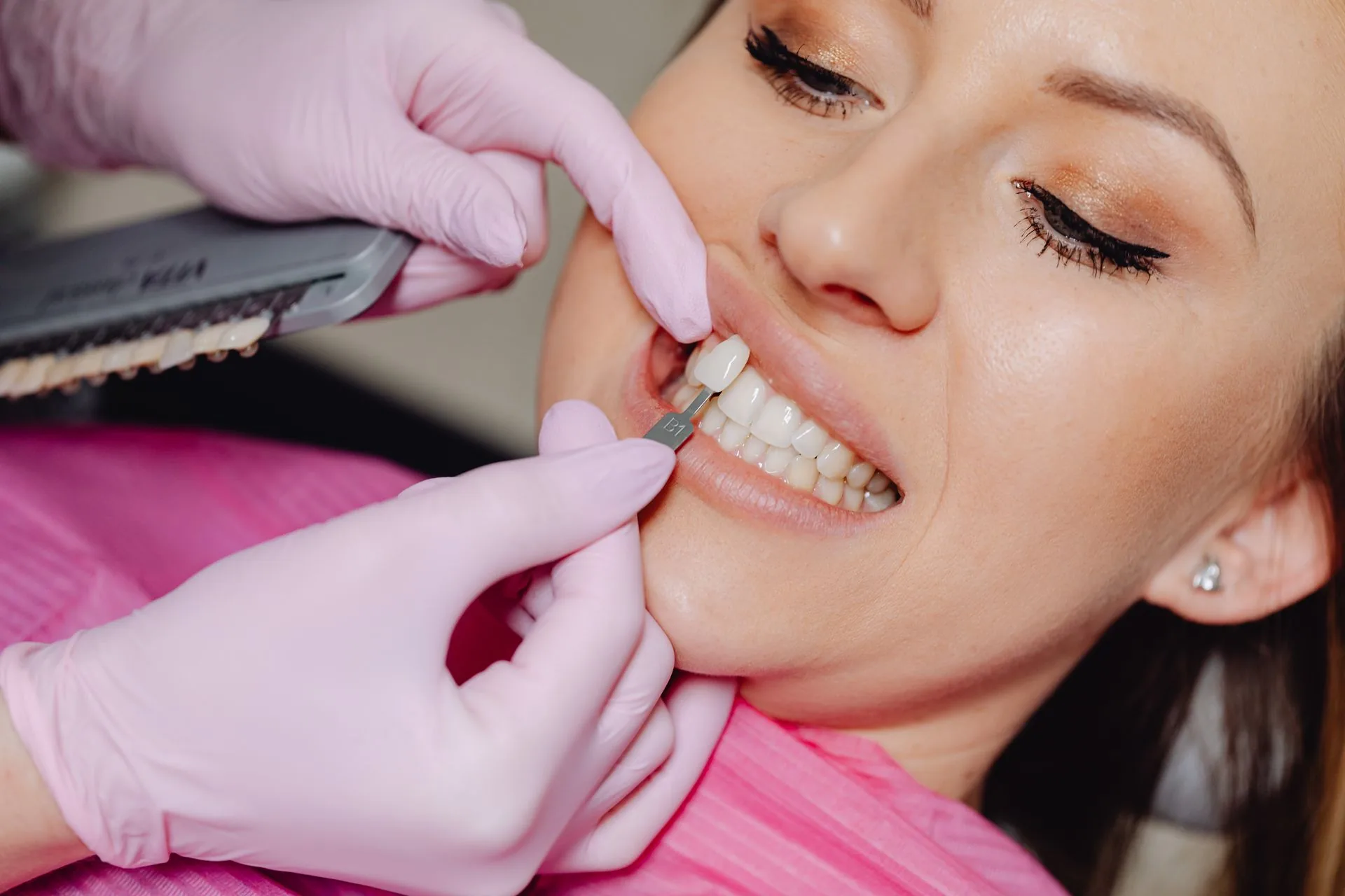 Veneers at Aurum Dental Clinic, Vadodara